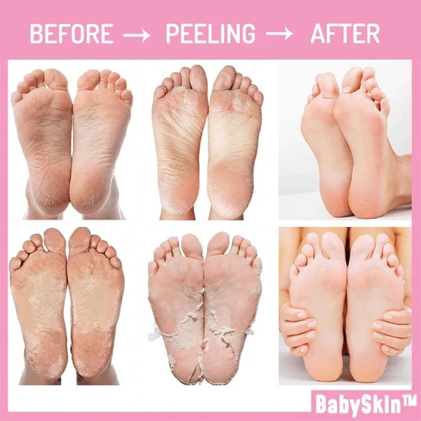 Baby Foot Exfoliation Peeling Mask