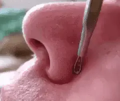 Blackhead Remover - Pimple Popper Removal Extractor Tool For Zit Popping