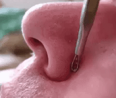 Blackhead Remover - Pimple Popper Removal Extractor Tool For Zit Popping