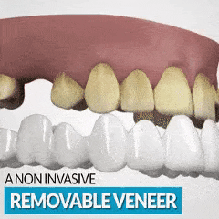 Snap On Pop On Teeth Veneers - Upper And Lower Set