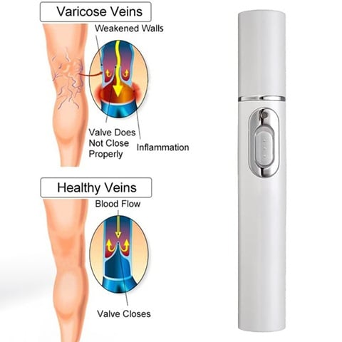 Therapeutic Blue Light Phototherapy - Therapy Treatment For Varicose & Spider Veins