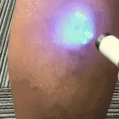 Therapeutic Blue Light Phototherapy - Therapy Treatment For Varicose & Spider Veins