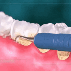 Ultrasonic Tooth Cleaner - Dental Scaler