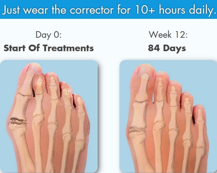 Bunion Corrector And Bunionette Splint - Toe Fixer Brace