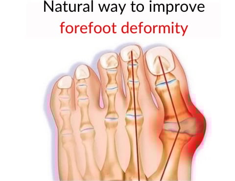 Bunion Corrector And Bunionette Splint - Toe Fixer Brace
