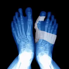 Bunion Corrector And Bunionette Splint - Toe Fixer Brace