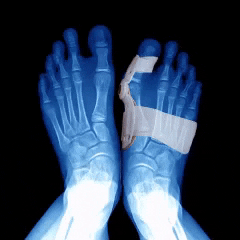 Bunion Corrector And Bunionette Splint - Toe Fixer Brace