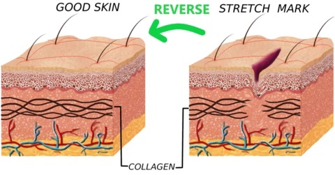 Stretch Mark Removal Cream