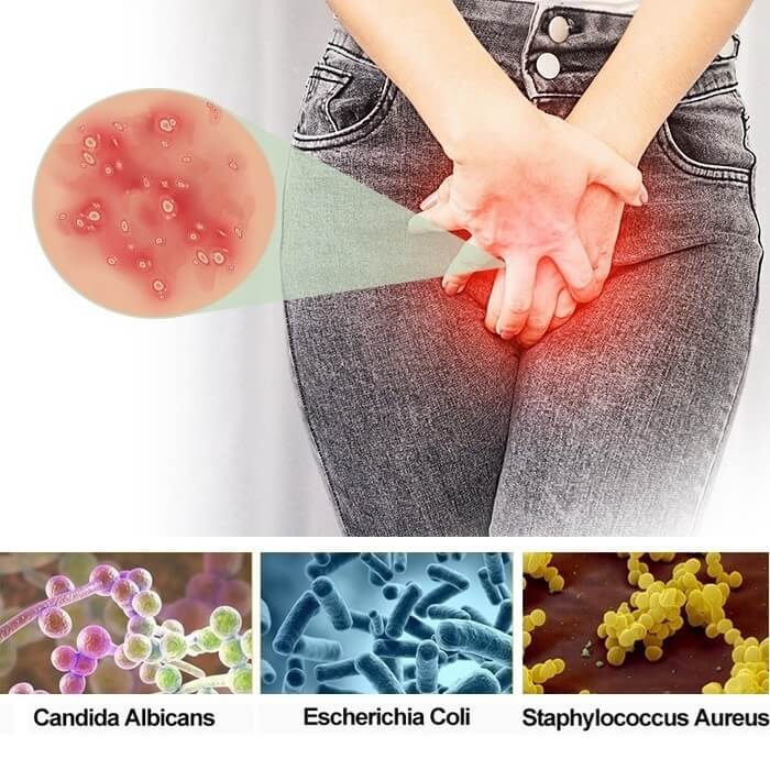 Vaginal Thrush Feminine Yeast Infection Treatment For Itchy Privates Female