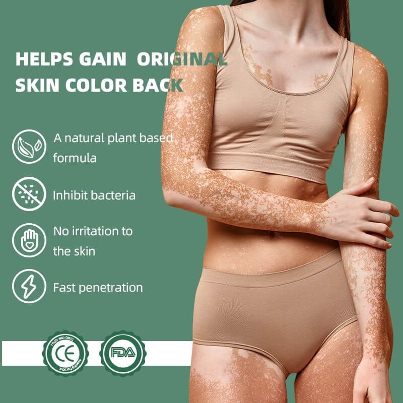 Vitiligo Disease Treatment - White Color Spot & Patches On Skin Therapy