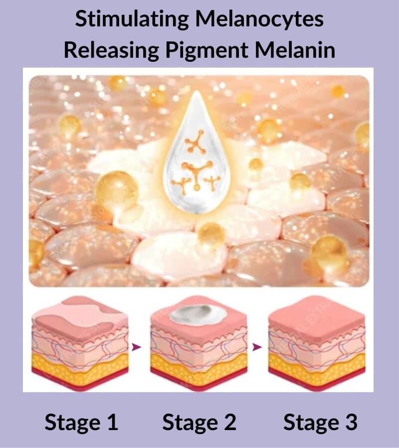 Vitiligo Disease Treatment - White Color Spot & Patches On Skin Therapy