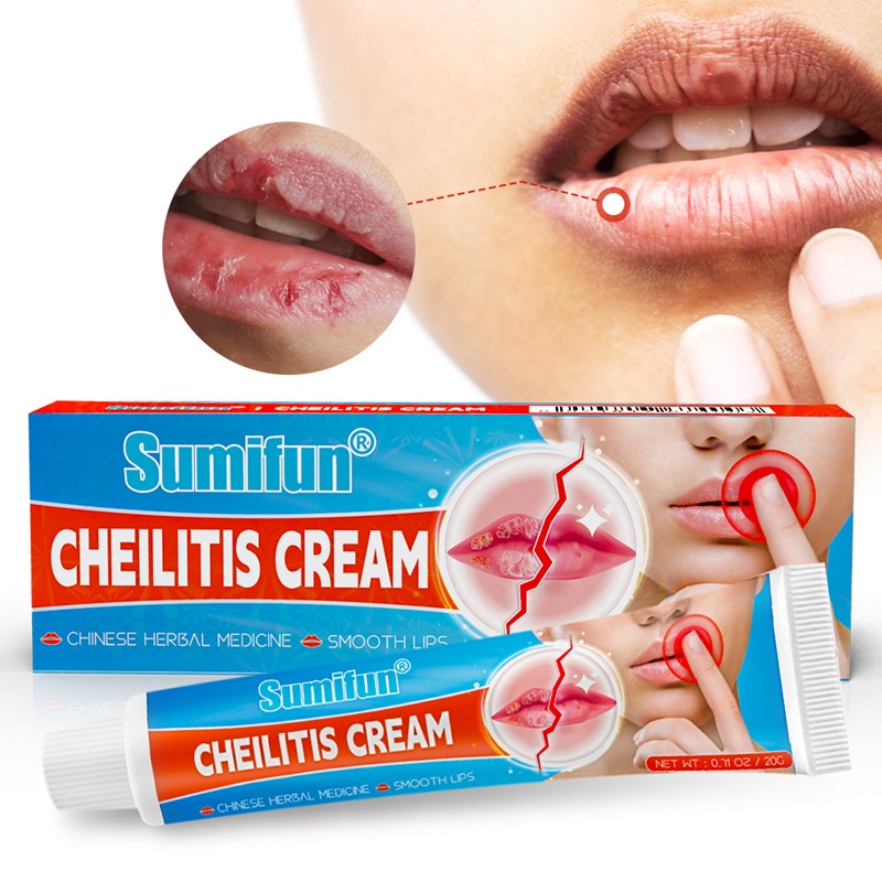 Angular Cheilitis & Perleche Treatment - Chapped Cracked Lip Corners & Cold Sore Of Mouth