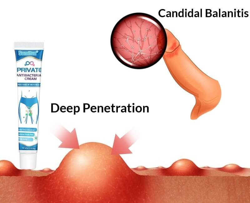 Cream For Candida In Men And Guy - Pennis Yeast Infection Treatment In Male Private Parts​