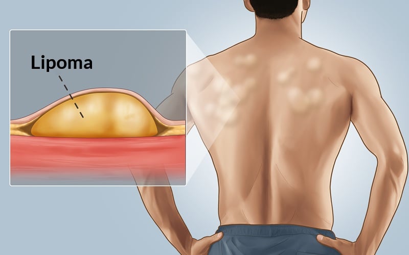 Lipoma Removal Cream - Remove Fatty Lump Tumor & Knot Under Skin Treatment At Home