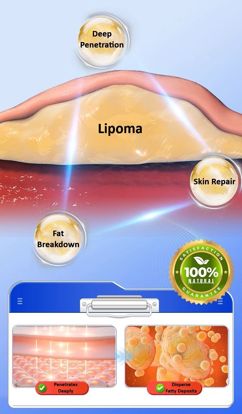 Lipoma Removal Cream - Remove Fatty Lump Tumor & Knot Under Skin Treatment At Home
