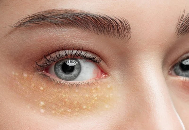 Little Hard White Bumps Pimples Dots On Face Skin Eyelids Cream - Spots Seed Under Around Eyes