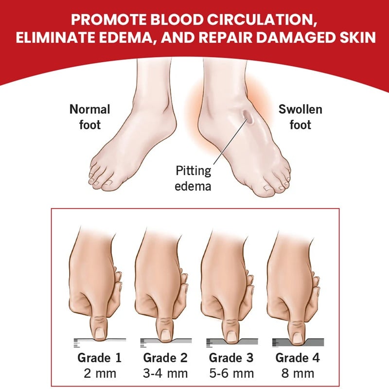 Edema & Feet Swelling Treatment - Water Retention In Swollen Legs & Puffy Ankles