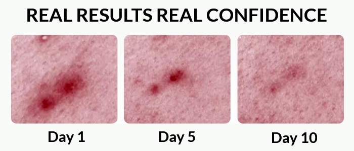 Acne Scar Spot Treatment Best For Cystic Fungal Hormonal Acne