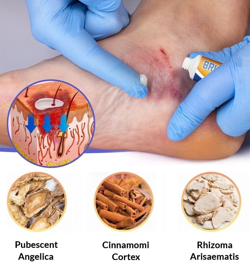 Deep Bruises Ointment & Hematoma Relief Home Treatment Cream For Bruising Bone & Bruised Rib