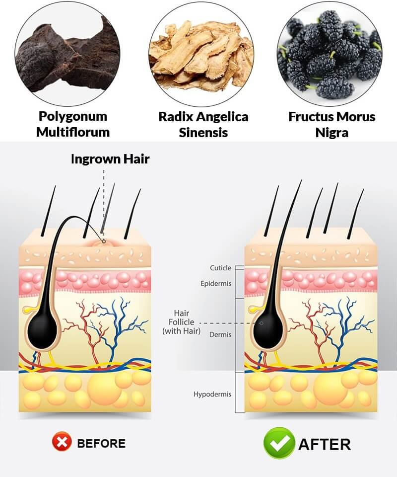 Infected Inflamed Ingrown Hair Treatment & Remedy For Hair Ingrowth At Home