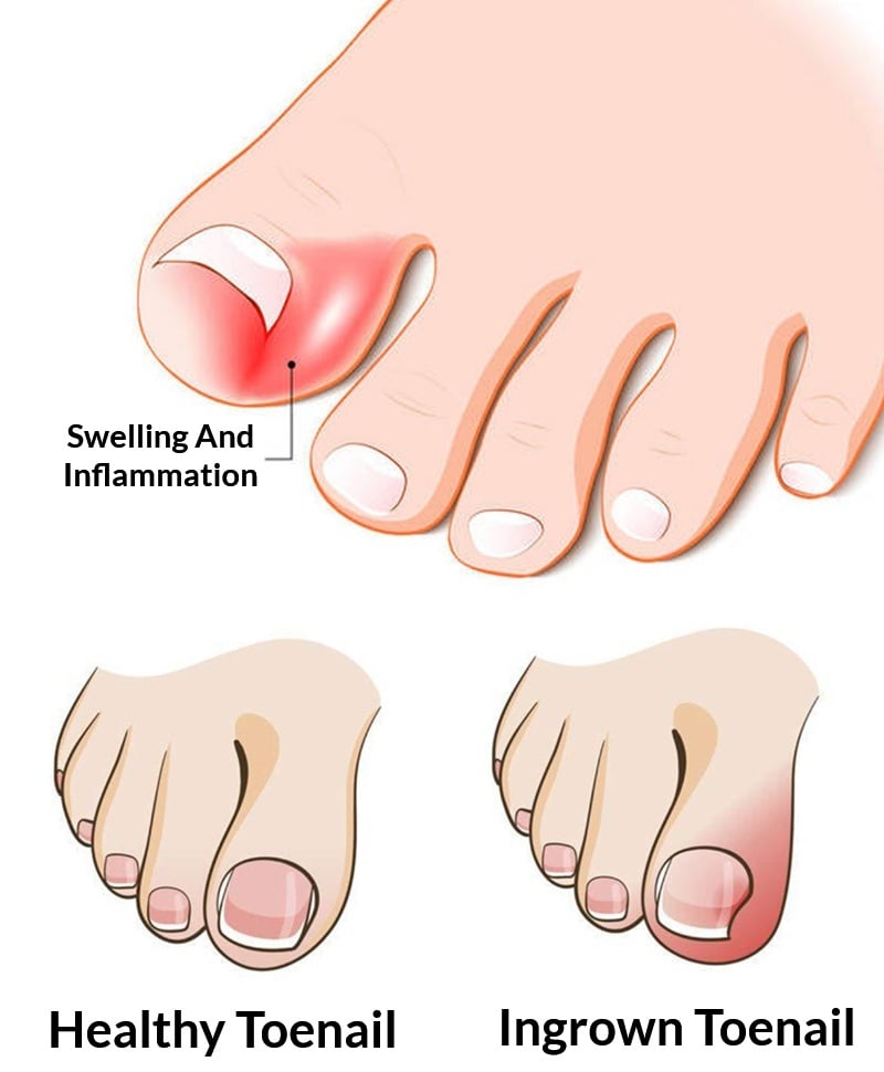 Ingrown Toenail​ Treatment​ - Paronychia & Cuticle Infection Self-Care​ Treatment​s At Home