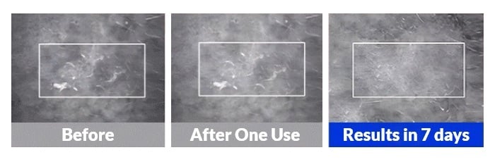 Keratosis Pilaris KP Chicken Skin Treatment - Self Care Urea Cream For Bumps In Arms Legs Face Butt