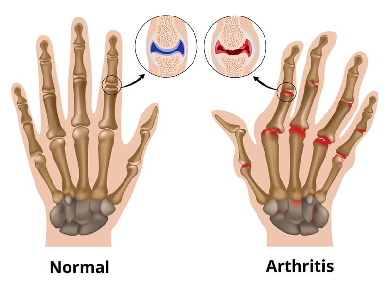 Rheumatoid Arthritis & Carpal Tunnel Syndrome Treatment - Tenosynovitis & Wrist Pain