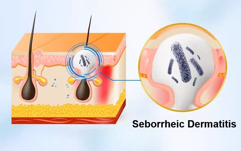Seborrheic Dermatitis Treatment For Eczema On Head Scalp Dandruff And Face