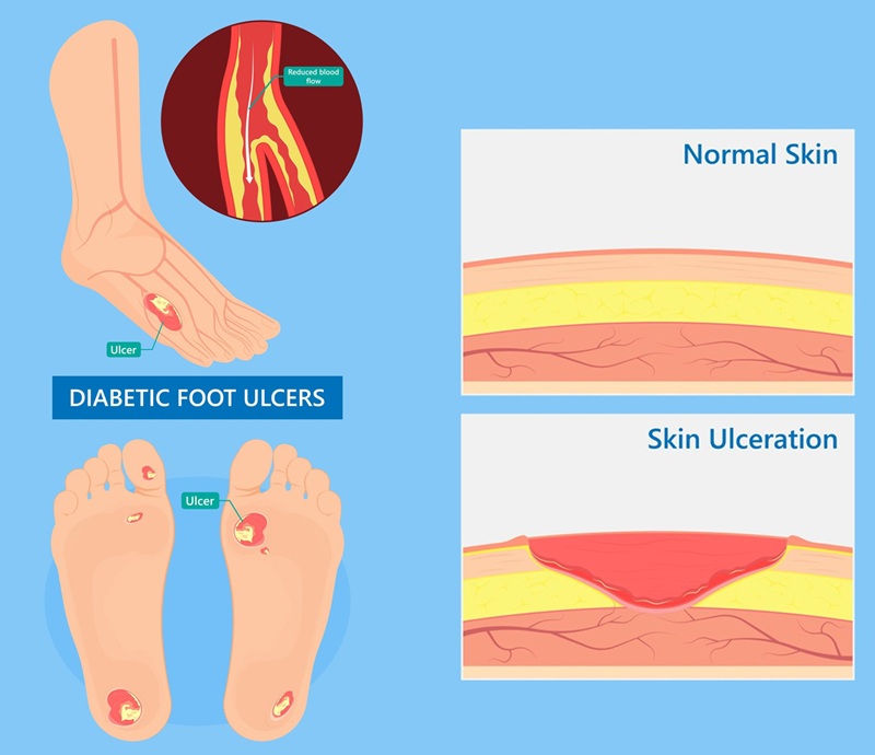Diabetic Foot Care Cream - Ulcer Treatment And Dry Itchy Cracked Feet