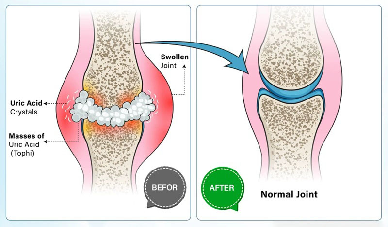 Gout & Pseudogout In Foot Disease Treatment - Immediate Pain Relief In Feet Knee Ankle Hand