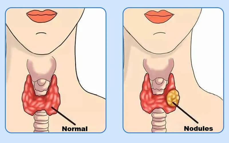 Hypothyroidism Natural Treatment - Enlarged Thyroid Gland Care