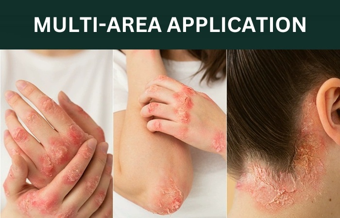 Plaque Psoriasis Rash Treatment On Scalp Face Hand Feet - Anti Itch & Scratch Skin Cream