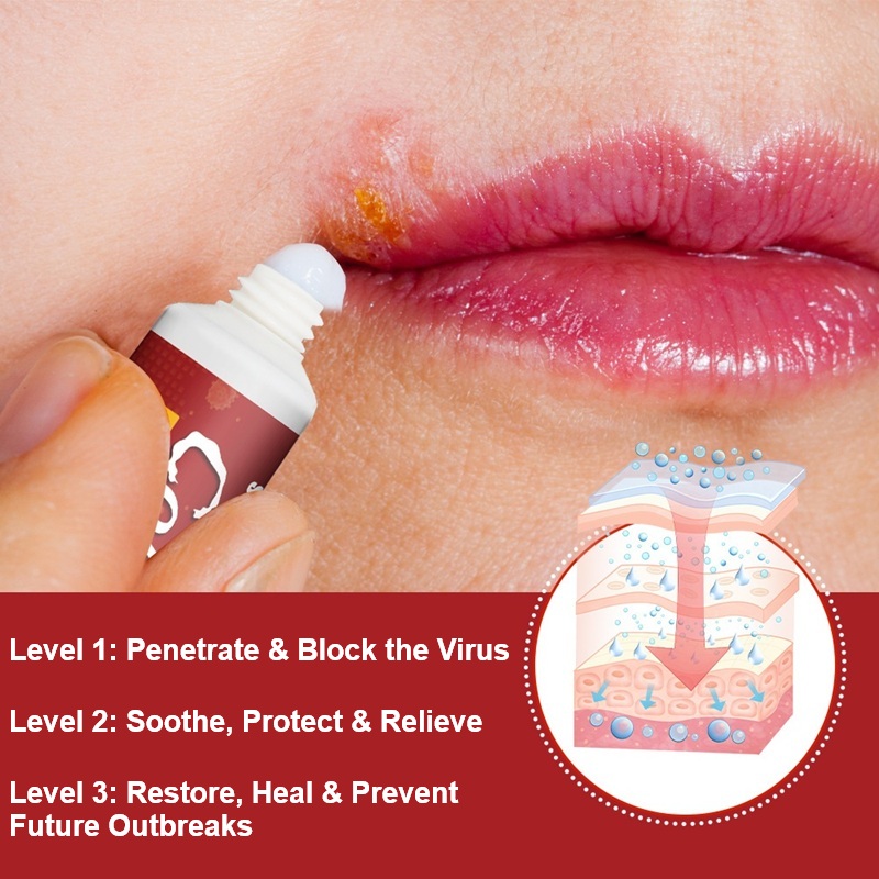 Cold Sore On Lip​ Self-care Treatment​ - Get Rid Of & Kills Cold Sores Fever Blisters Treatments