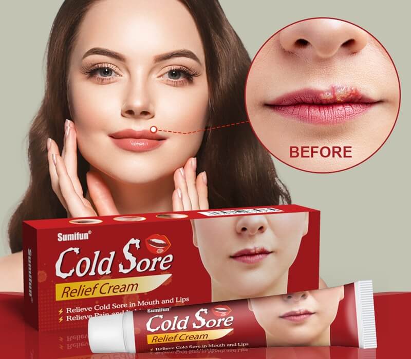 Cold Sore On Lip​ Self-care Treatment​ - Get Rid Of & Kills Cold Sores Fever Blisters Treatments