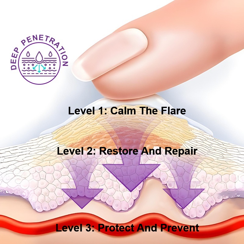 Dyshidrosis Feet Treatments & Pompholyx Eczema Treatment Cream