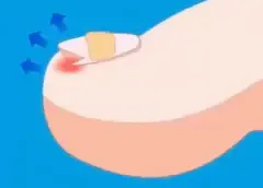 Paronychia Treatment & Fix Infected Ingrown Toenail - Self-Care​ Treatment At Home